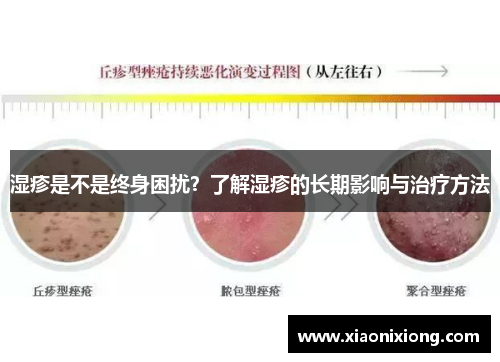湿疹是不是终身困扰?了解湿疹的长期影响与治疗方法 湿疹是不是终身困扰?了解湿疹的长期影响与治疗方法